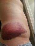 Bruise 2.PNG